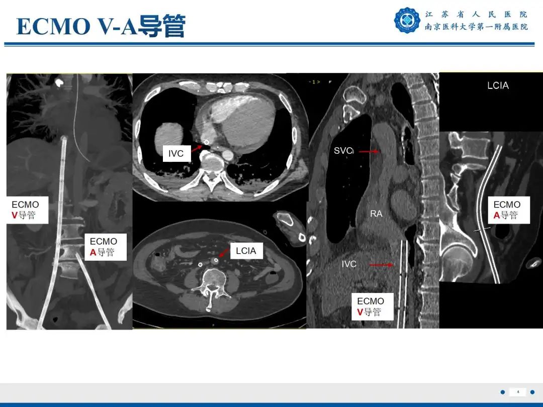 影像PPT - 【PPT】静脉动脉体外膜肺氧合CTA成像-5
