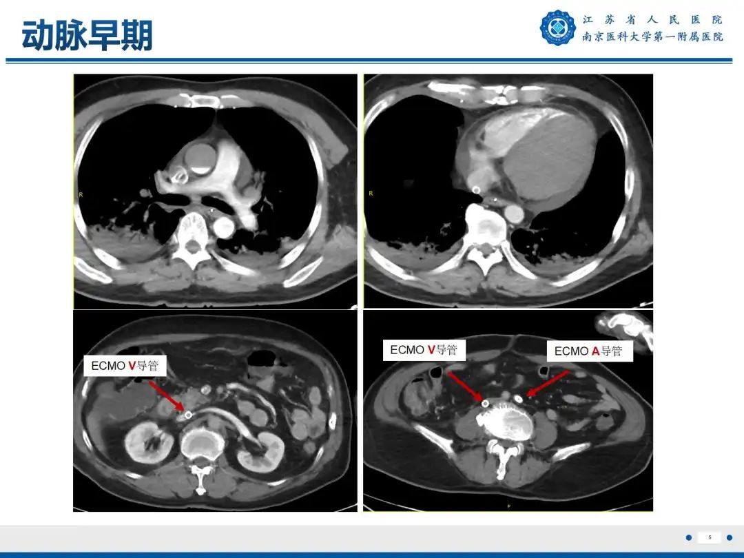 影像PPT - 【PPT】静脉动脉体外膜肺氧合CTA成像-6