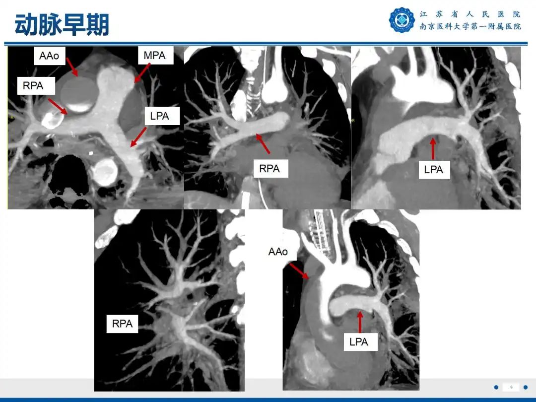 影像PPT - 【PPT】静脉动脉体外膜肺氧合CTA成像-7