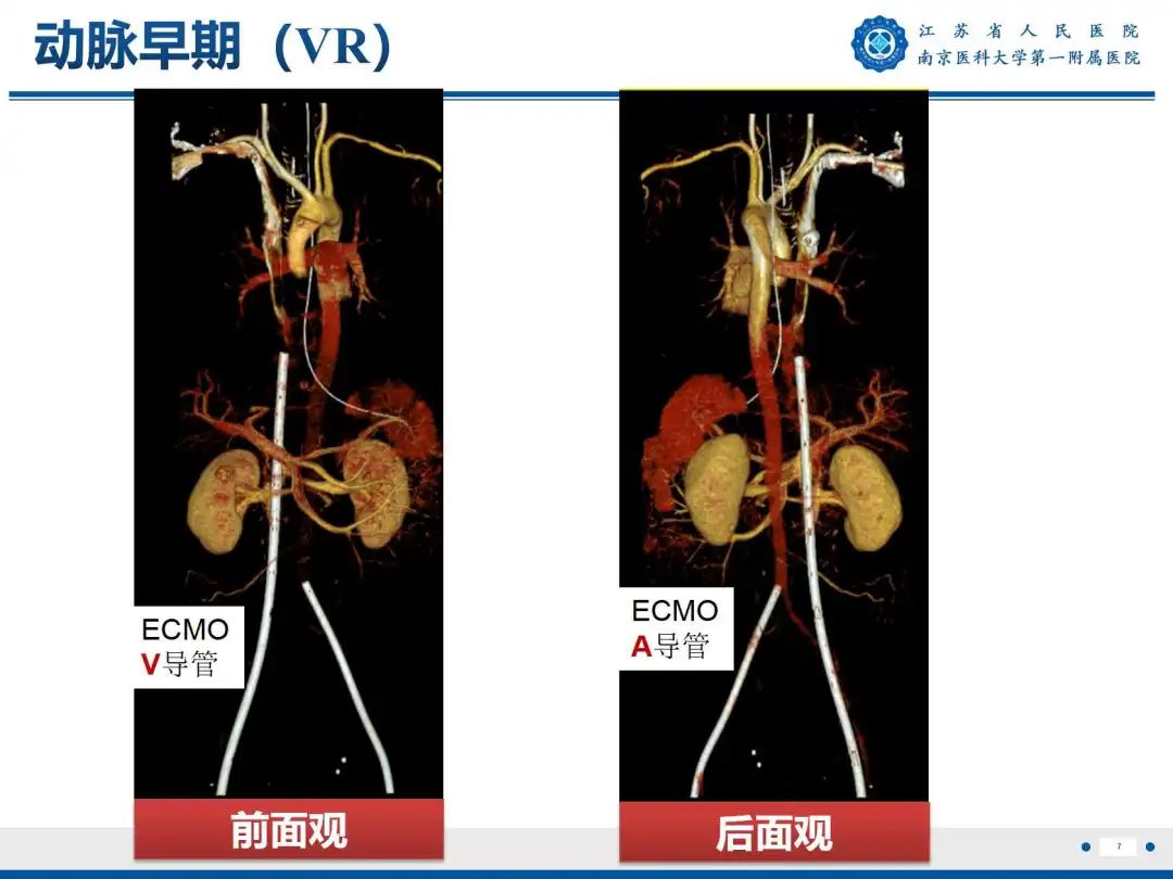 影像PPT - 【PPT】静脉动脉体外膜肺氧合CTA成像-8