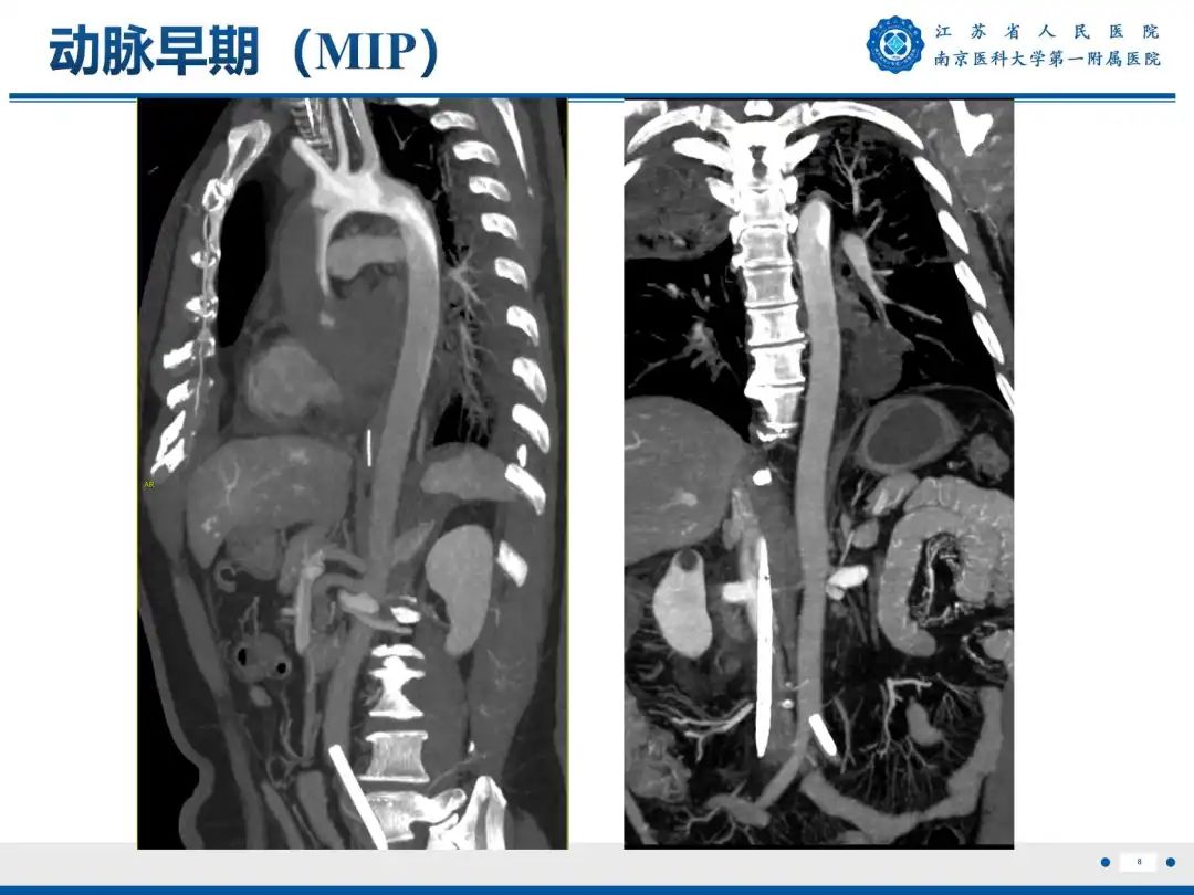 影像PPT - 【PPT】静脉动脉体外膜肺氧合CTA成像-9