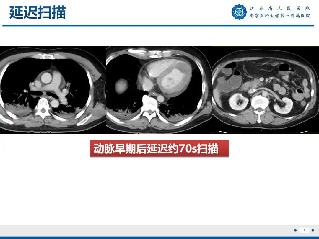 影像PPT - 【PPT】静脉动脉体外膜肺氧合CTA成像-10