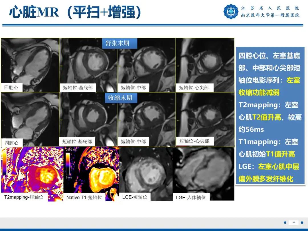 影像PPT - 【PPT】静脉动脉体外膜肺氧合CTA成像-20