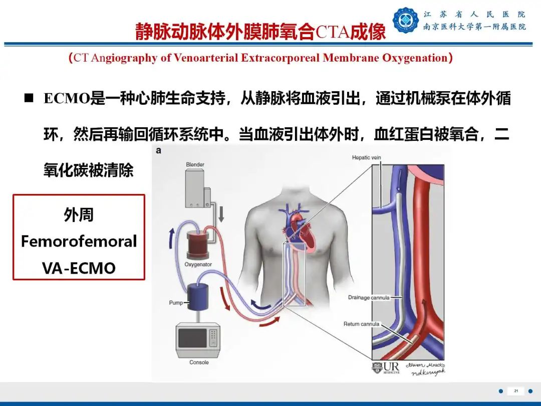 影像PPT - 【PPT】静脉动脉体外膜肺氧合CTA成像-22