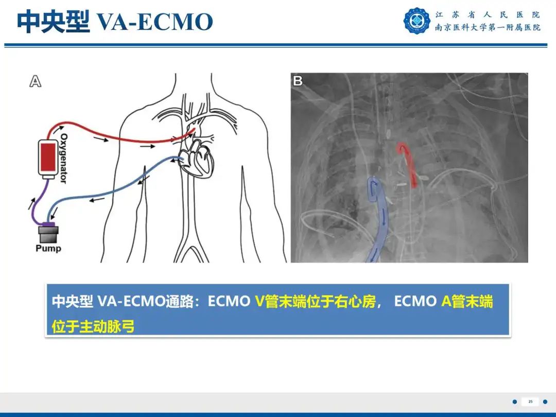 影像PPT - 【PPT】静脉动脉体外膜肺氧合CTA成像-26