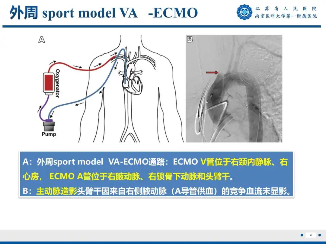 影像PPT - 【PPT】静脉动脉体外膜肺氧合CTA成像-28