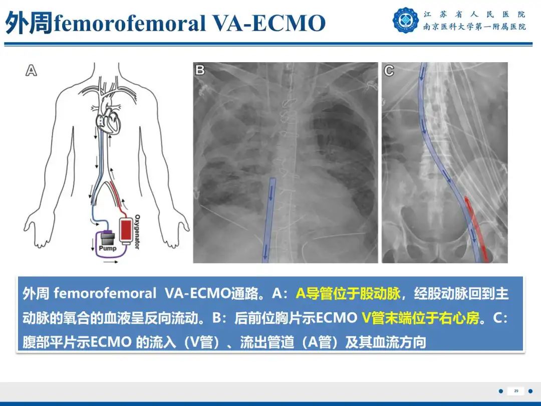 影像PPT - 【PPT】静脉动脉体外膜肺氧合CTA成像-30