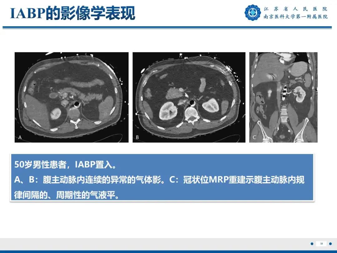 影像PPT - 【PPT】静脉动脉体外膜肺氧合CTA成像-33