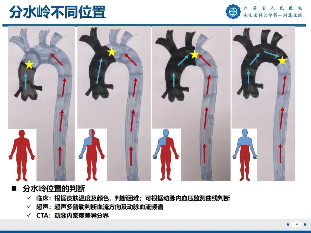 影像PPT - 【PPT】静脉动脉体外膜肺氧合CTA成像-35