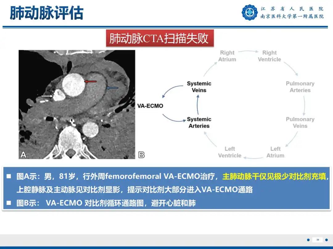 影像PPT - 【PPT】静脉动脉体外膜肺氧合CTA成像-40