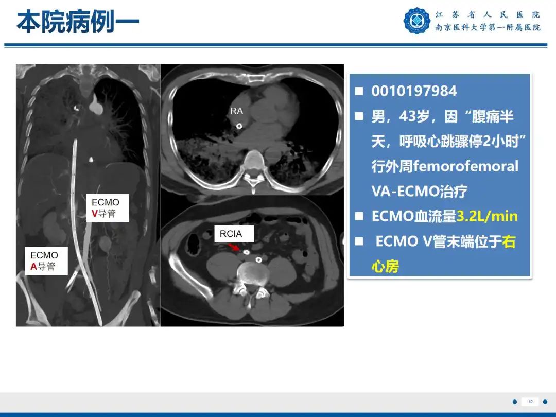 影像PPT - 【PPT】静脉动脉体外膜肺氧合CTA成像-41