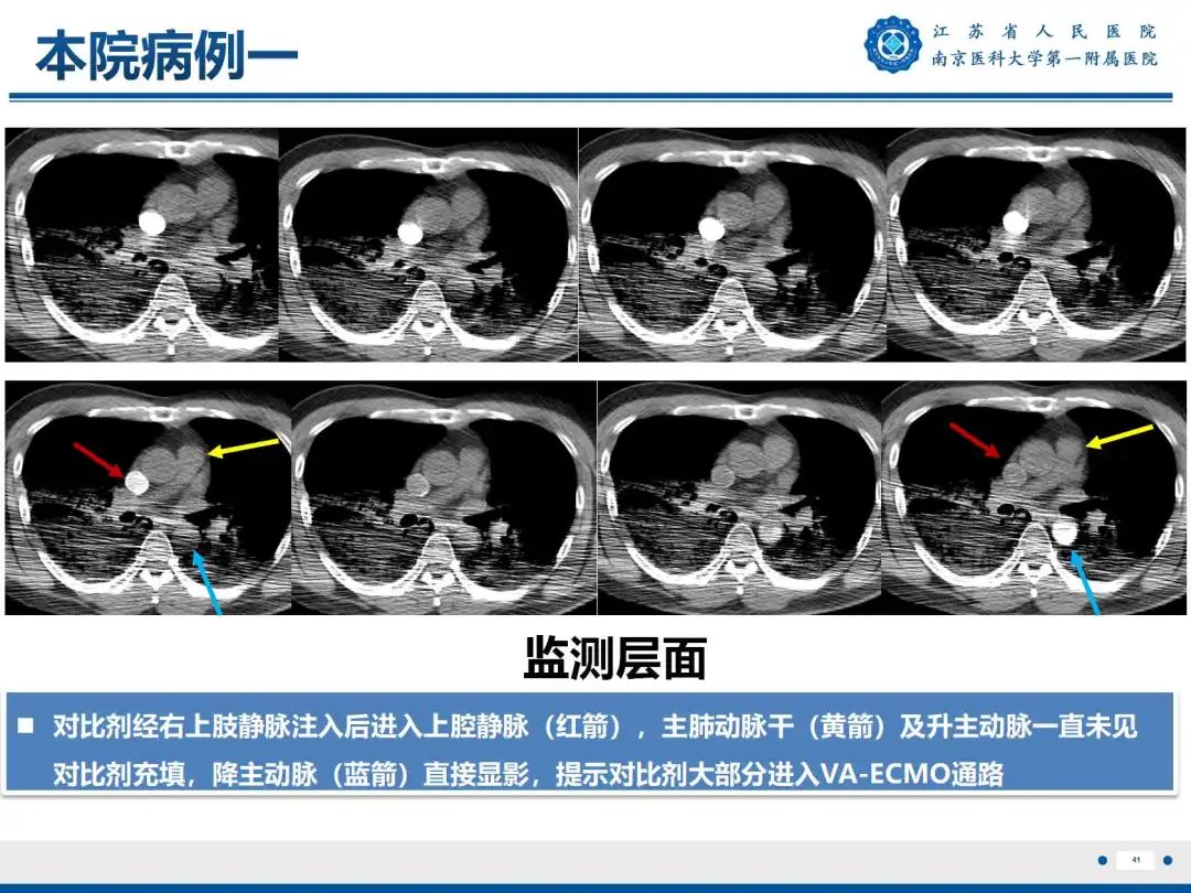 影像PPT - 【PPT】静脉动脉体外膜肺氧合CTA成像-42