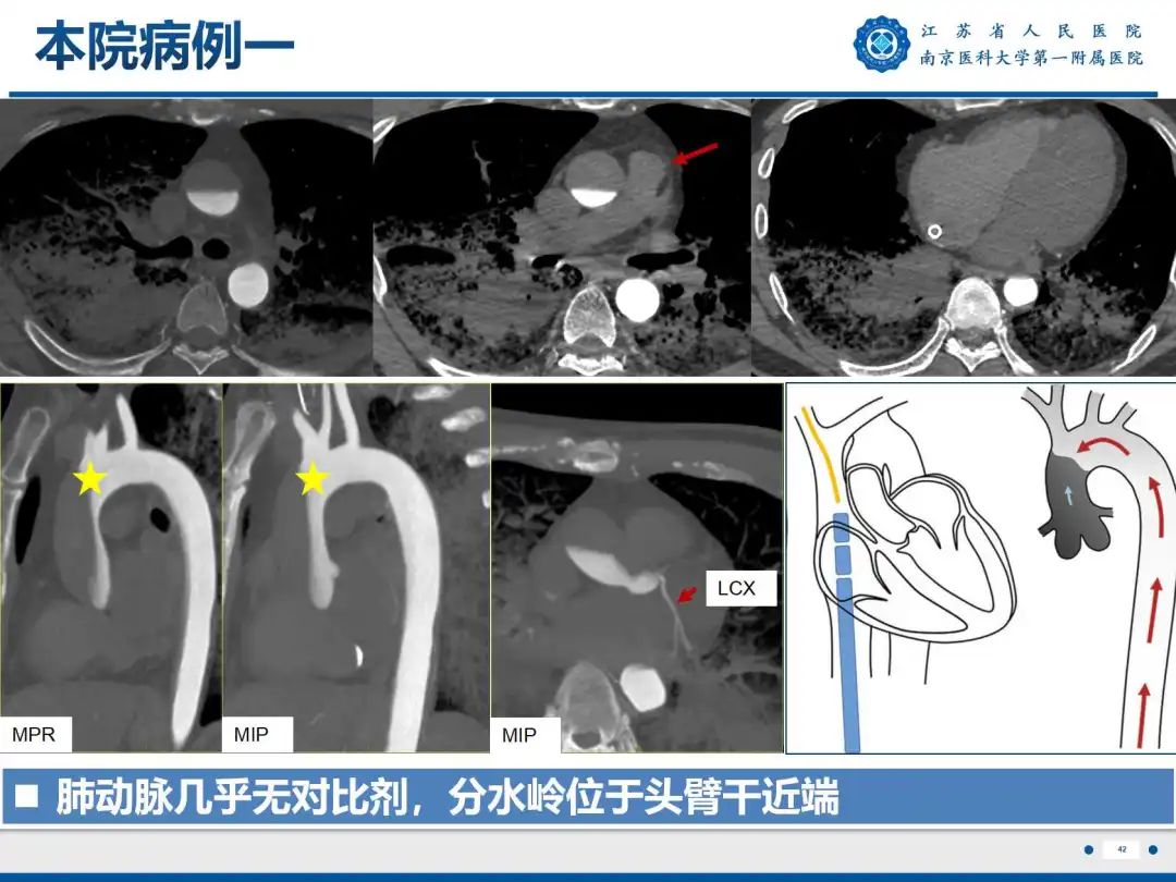 影像PPT - 【PPT】静脉动脉体外膜肺氧合CTA成像-43