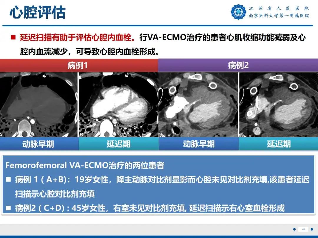 影像PPT - 【PPT】静脉动脉体外膜肺氧合CTA成像-45