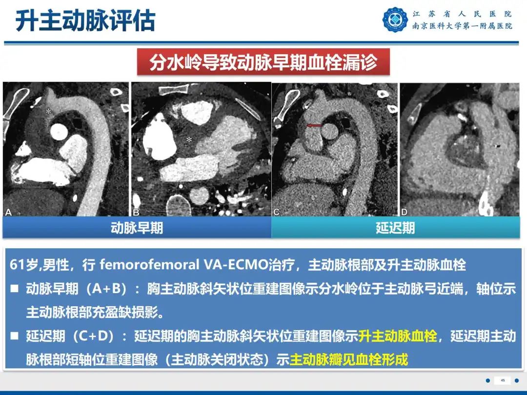 影像PPT - 【PPT】静脉动脉体外膜肺氧合CTA成像-46