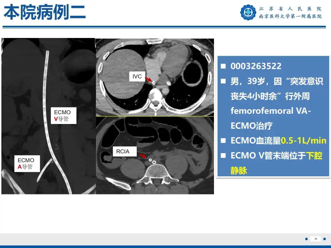 影像PPT - 【PPT】静脉动脉体外膜肺氧合CTA成像-47