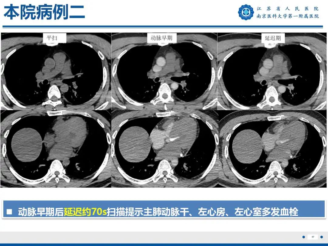 影像PPT - 【PPT】静脉动脉体外膜肺氧合CTA成像-48