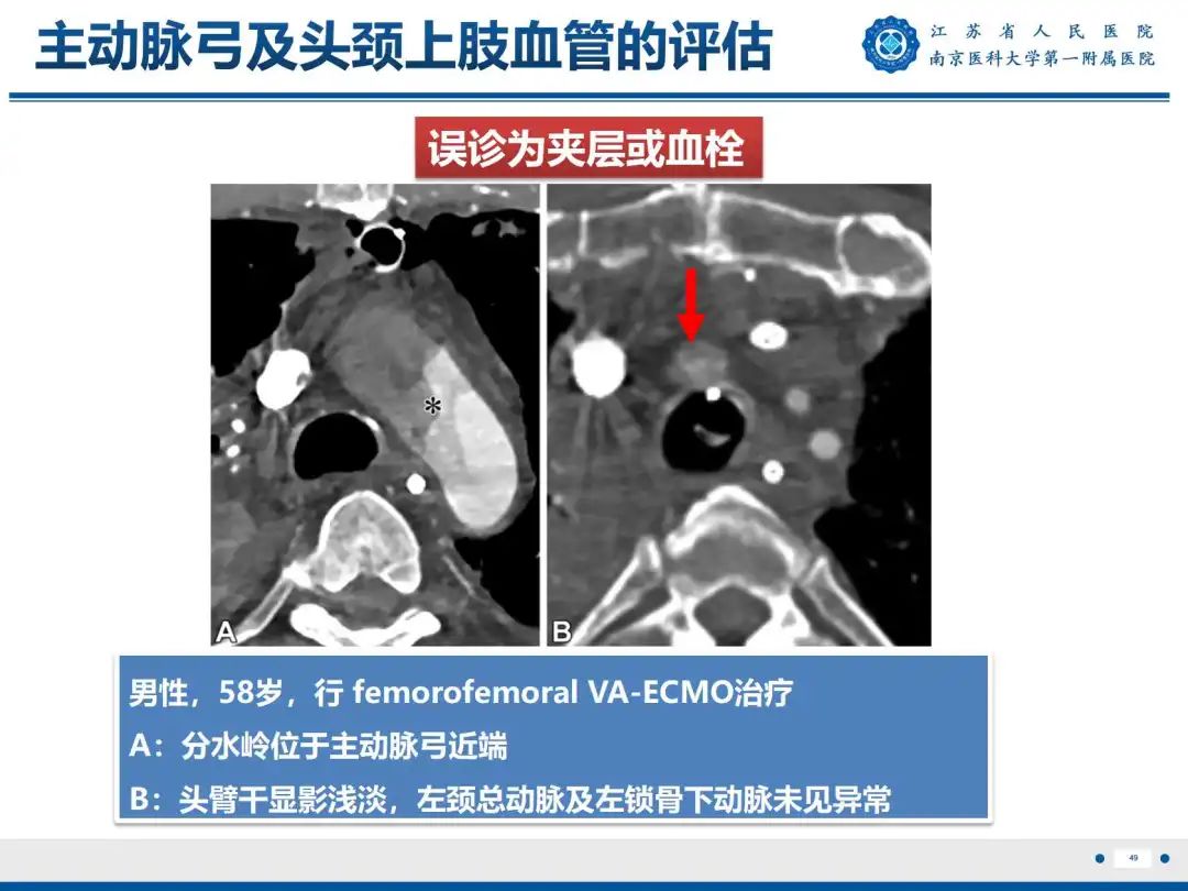 影像PPT - 【PPT】静脉动脉体外膜肺氧合CTA成像-50