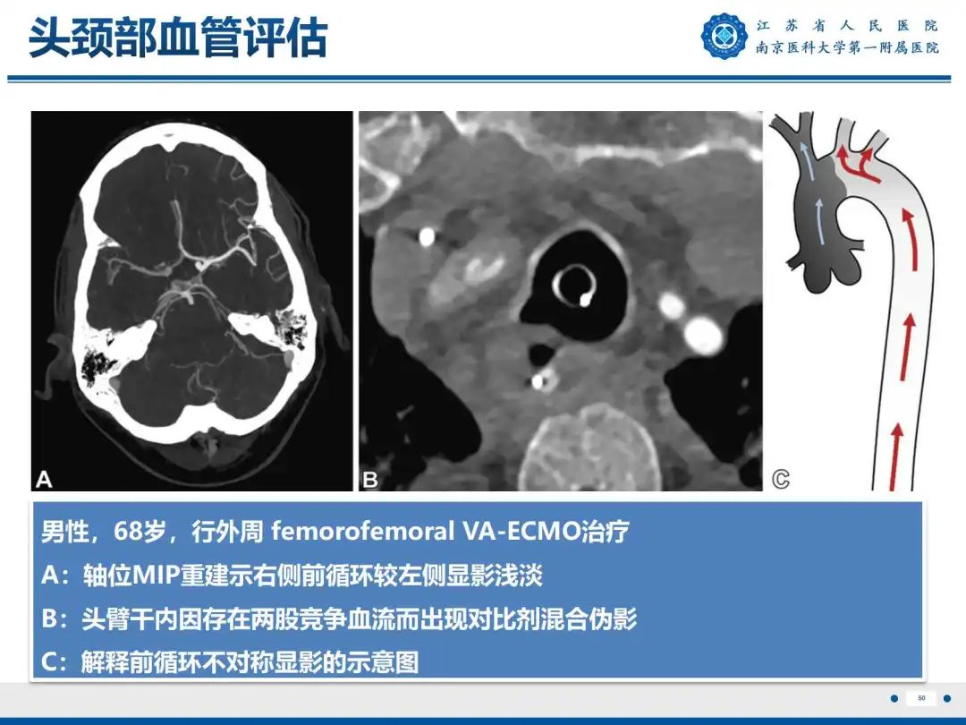 影像PPT - 【PPT】静脉动脉体外膜肺氧合CTA成像-51