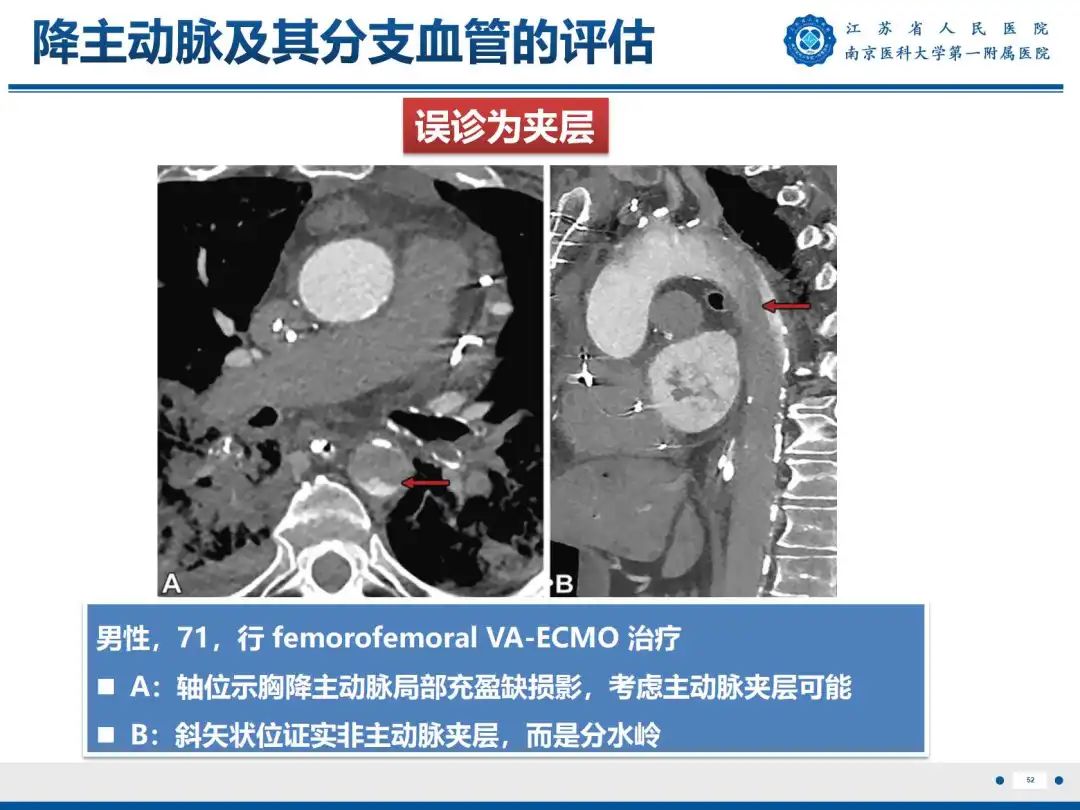 影像PPT - 【PPT】静脉动脉体外膜肺氧合CTA成像-53