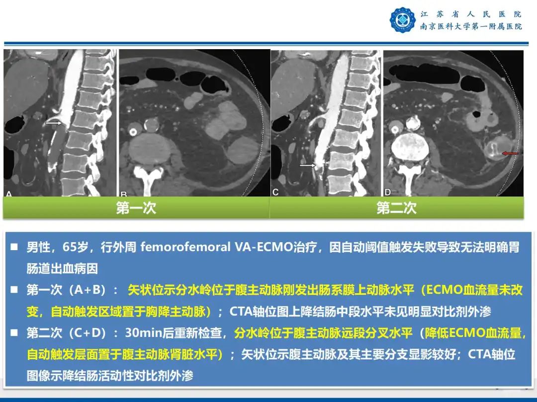 影像PPT - 【PPT】静脉动脉体外膜肺氧合CTA成像-54