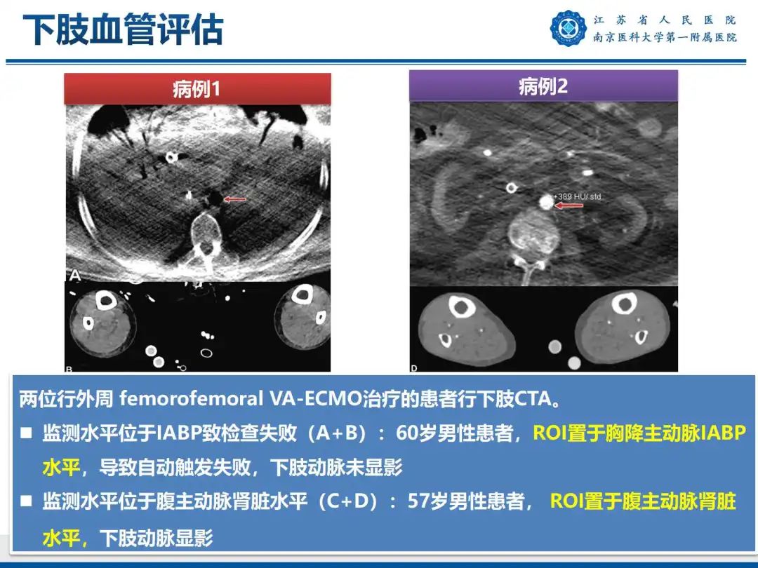 影像PPT - 【PPT】静脉动脉体外膜肺氧合CTA成像-56