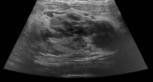 影像PPT - 【病例】乳腺错构瘤2例X线及MR影像-4 影像PPT - 【病例】乳腺错构瘤2例X线及MR影像-4