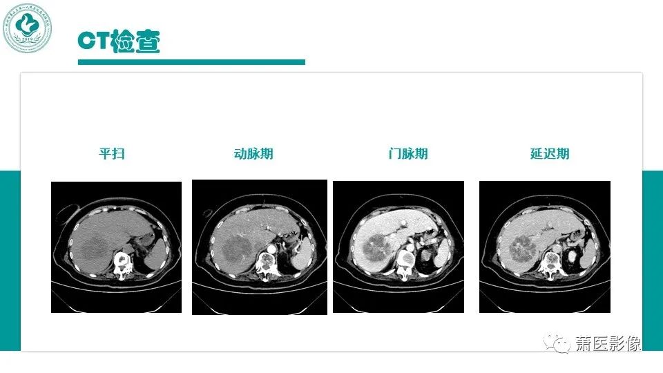 影像PPT - 【病例】细菌性肝脓肿 VS 胆管细胞癌-3