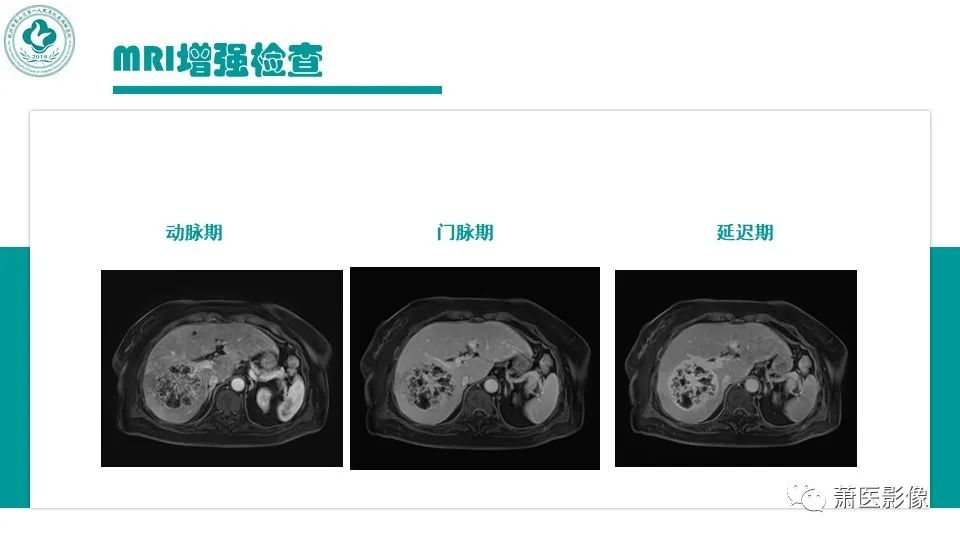 影像PPT - 【病例】细菌性肝脓肿 VS 胆管细胞癌-5