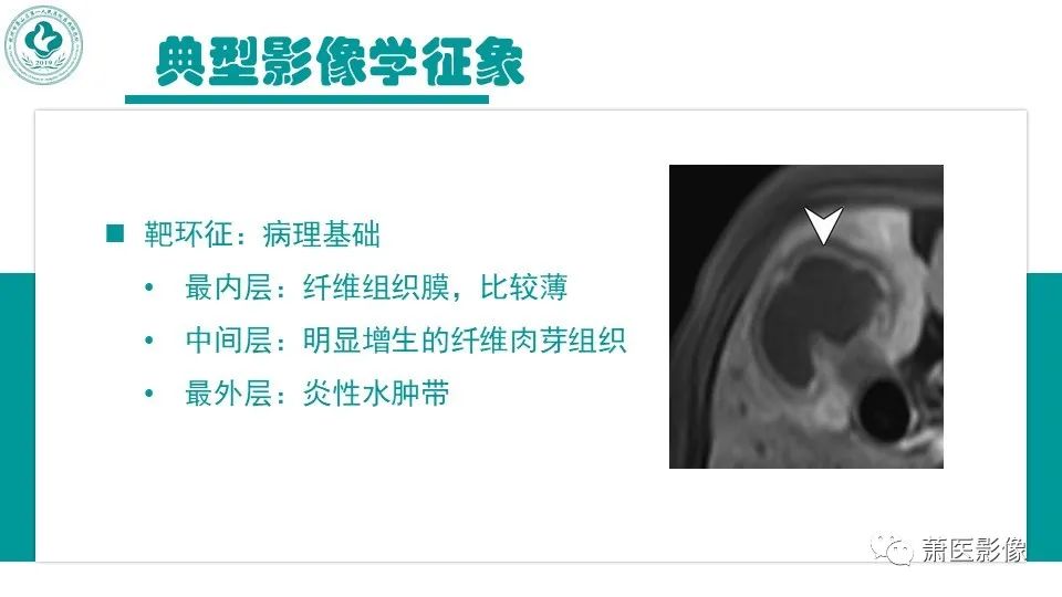 影像PPT - 【病例】细菌性肝脓肿 VS 胆管细胞癌-14