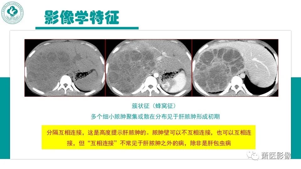 影像PPT - 【病例】细菌性肝脓肿 VS 胆管细胞癌-17