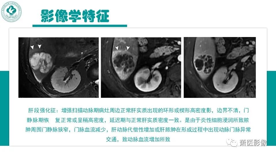 影像PPT - 【病例】细菌性肝脓肿 VS 胆管细胞癌-18