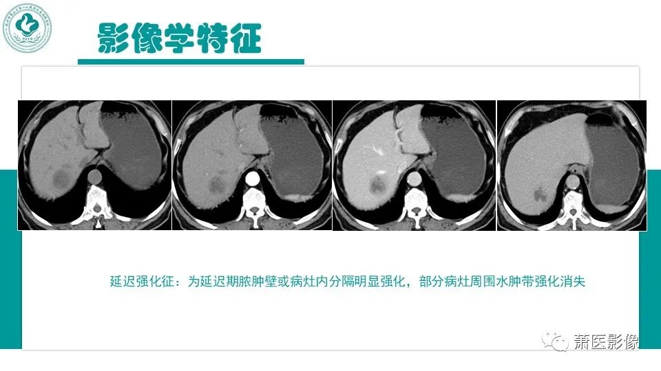 影像PPT - 【病例】细菌性肝脓肿 VS 胆管细胞癌-19