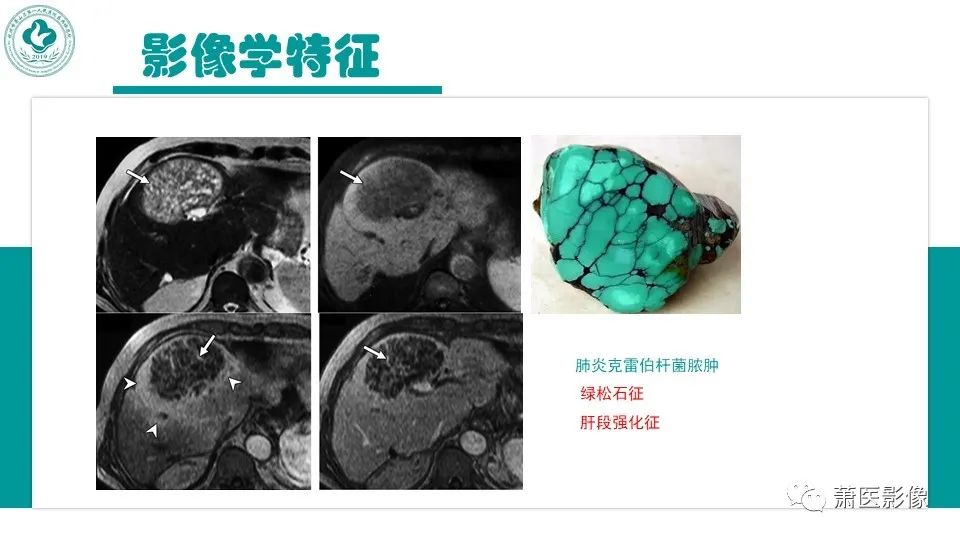 影像PPT - 【病例】细菌性肝脓肿 VS 胆管细胞癌-20