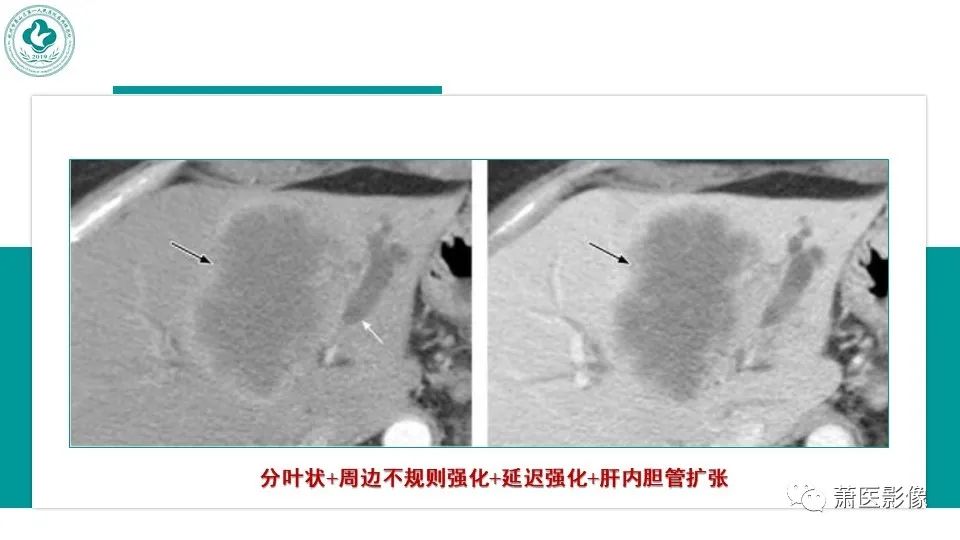 影像PPT - 【病例】细菌性肝脓肿 VS 胆管细胞癌-28
