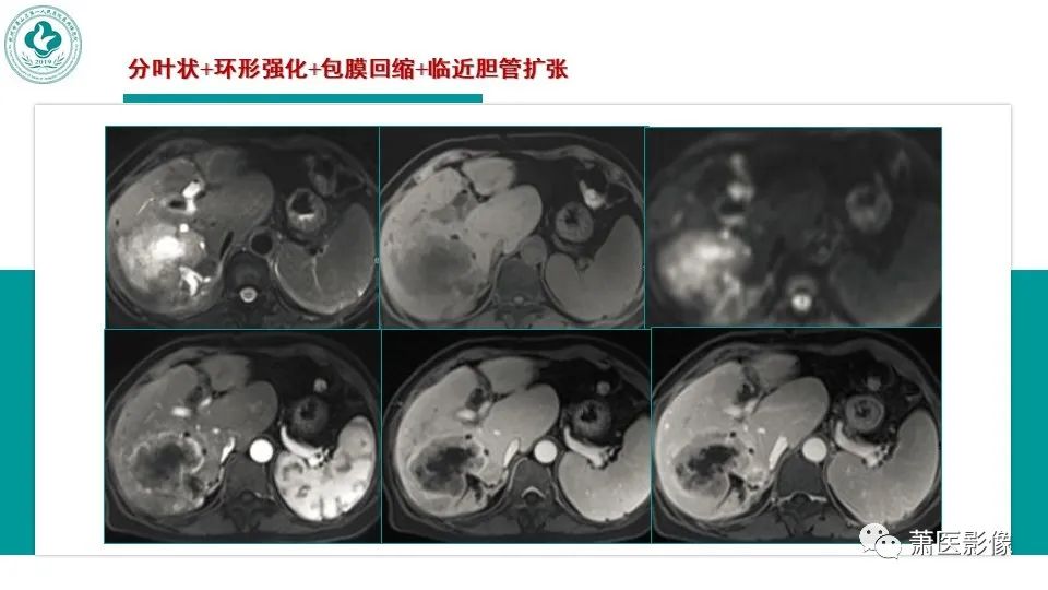 影像PPT - 【病例】细菌性肝脓肿 VS 胆管细胞癌-29