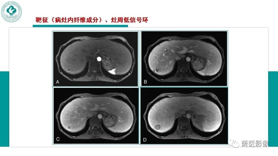 影像PPT - 【病例】细菌性肝脓肿 VS 胆管细胞癌-30