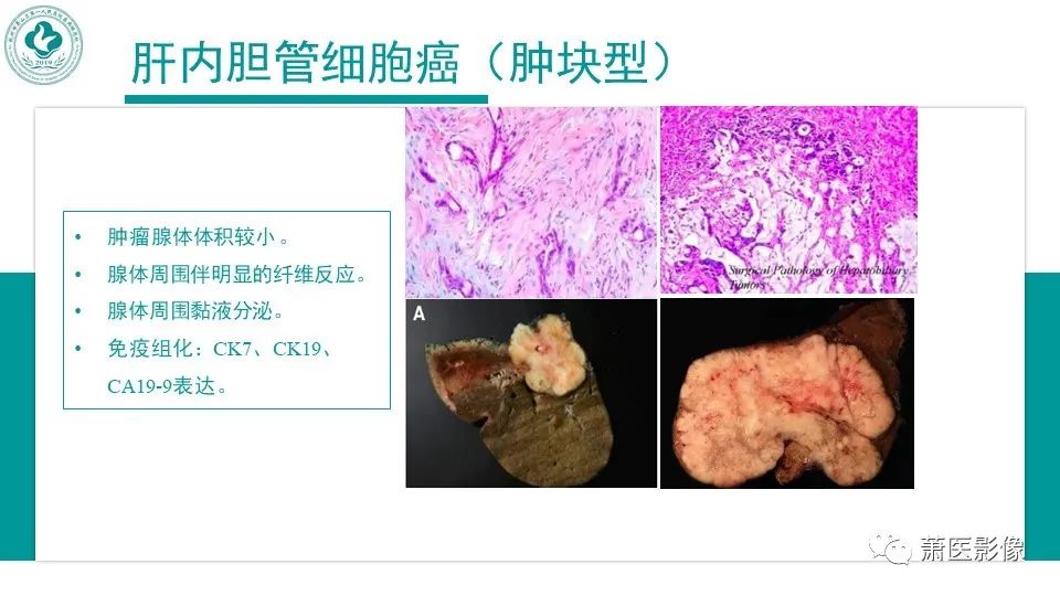 影像PPT - 【病例】细菌性肝脓肿 VS 胆管细胞癌-31