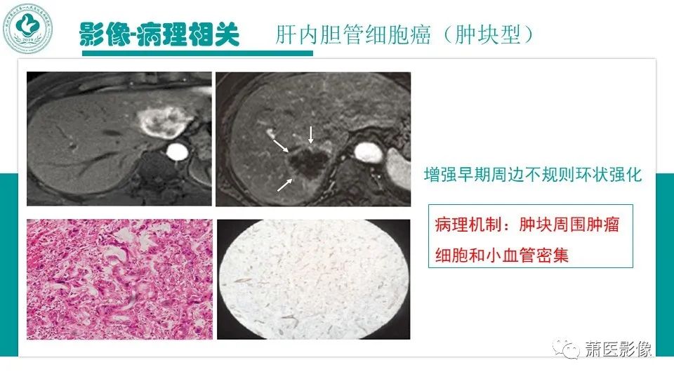 影像PPT - 【病例】细菌性肝脓肿 VS 胆管细胞癌-32