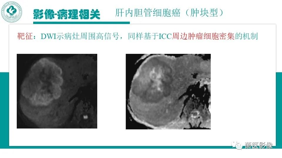 影像PPT - 【病例】细菌性肝脓肿 VS 胆管细胞癌-34