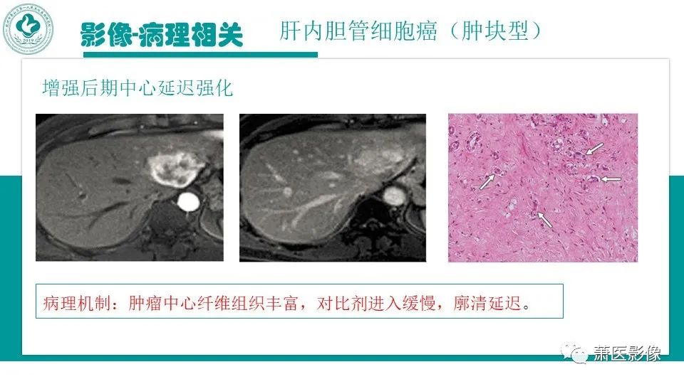 影像PPT - 【病例】细菌性肝脓肿 VS 胆管细胞癌-35