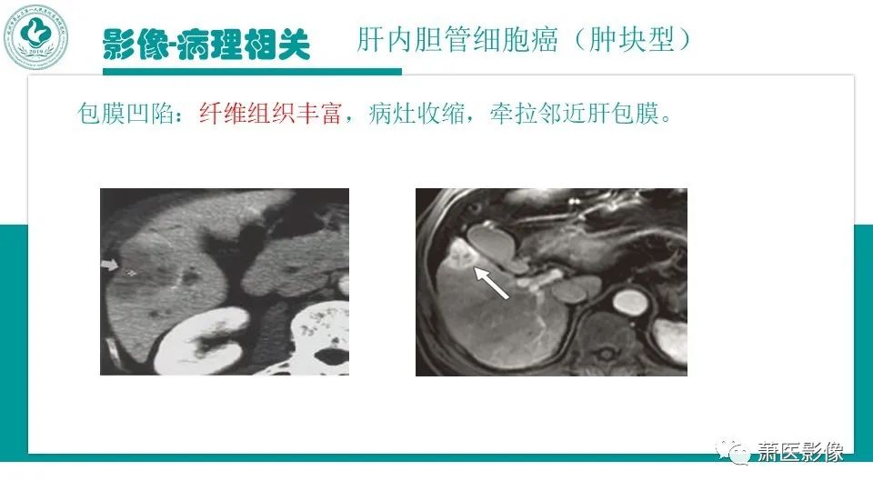 影像PPT - 【病例】细菌性肝脓肿 VS 胆管细胞癌-36