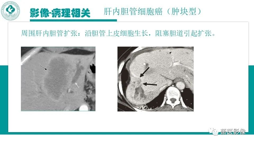 影像PPT - 【病例】细菌性肝脓肿 VS 胆管细胞癌-37