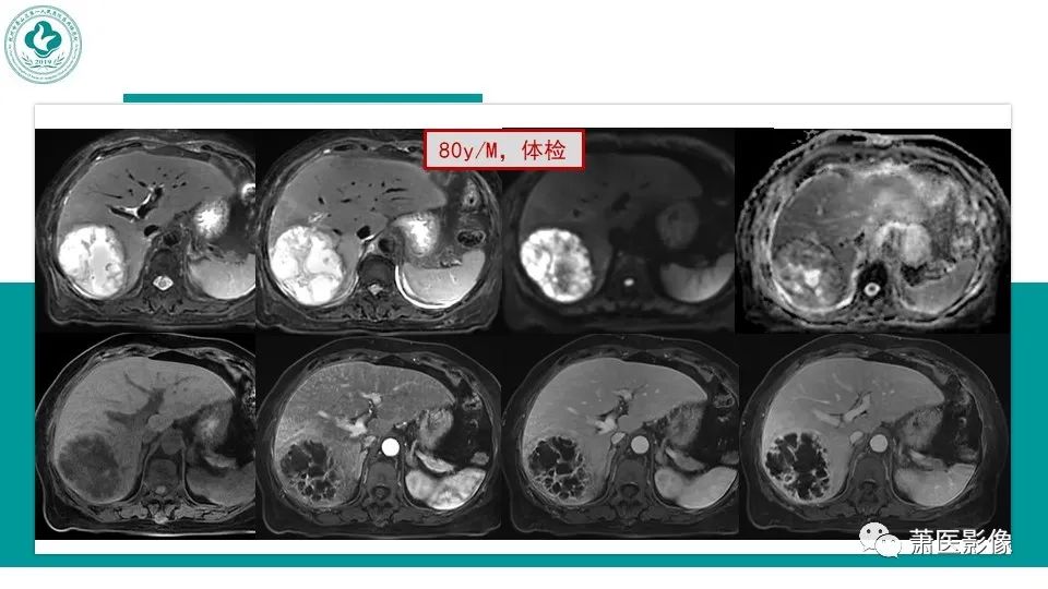 影像PPT - 【病例】细菌性肝脓肿 VS 胆管细胞癌-43