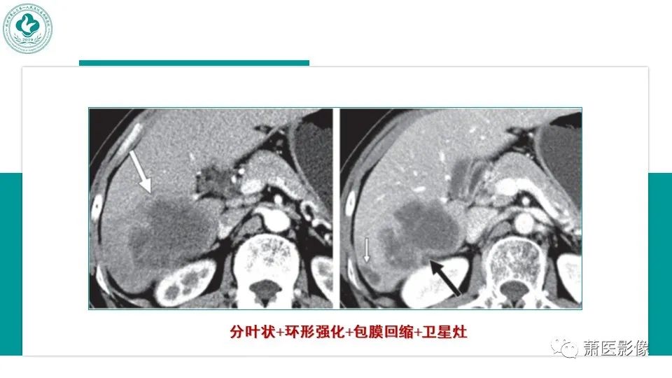 影像PPT - 【病例】细菌性肝脓肿 VS 胆管细胞癌-1