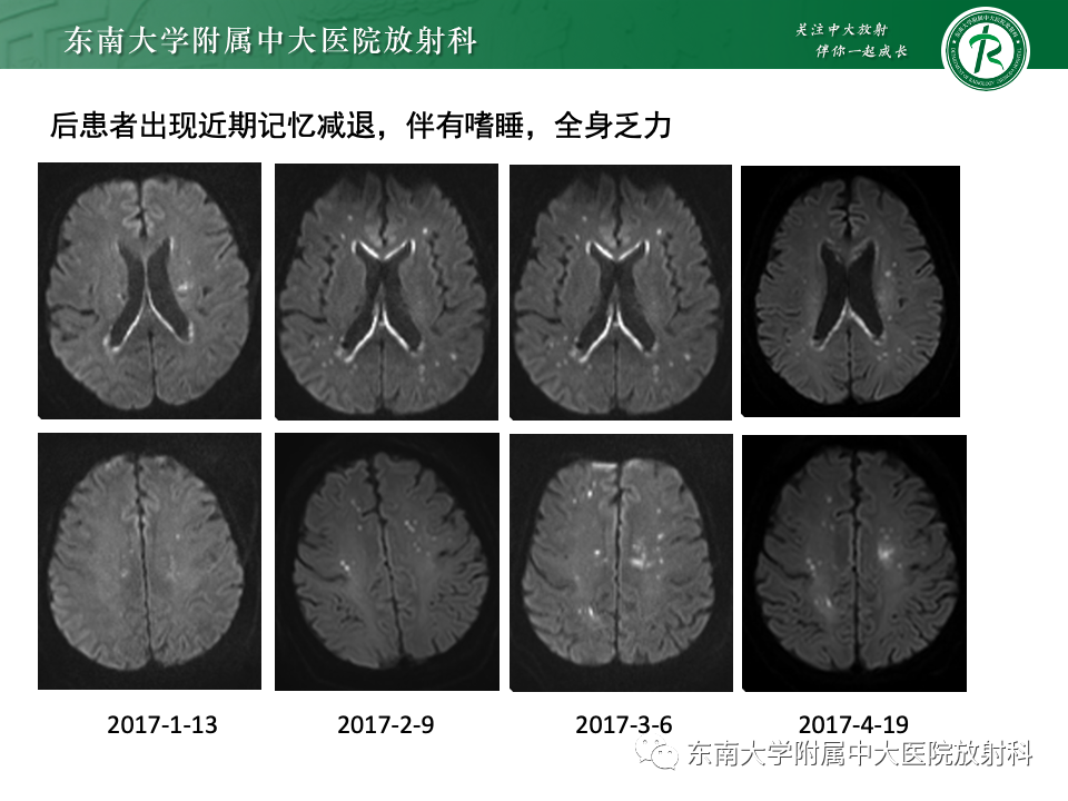 影像PPT - 【PPT】成人常见脑白质病变影像诊断-3