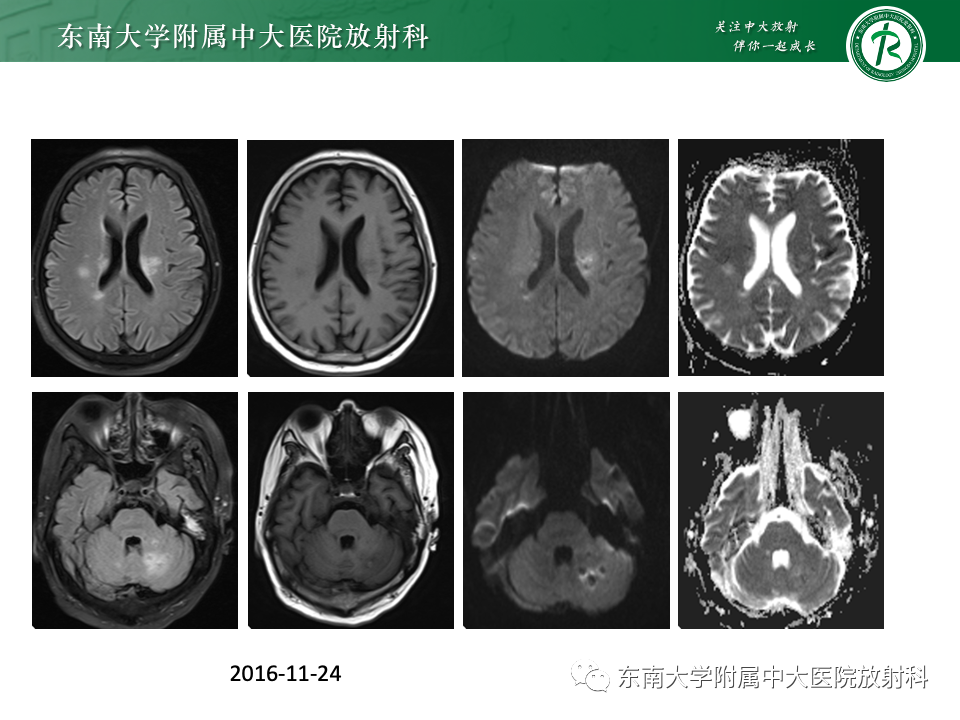 影像PPT - 【PPT】成人常见脑白质病变影像诊断-2