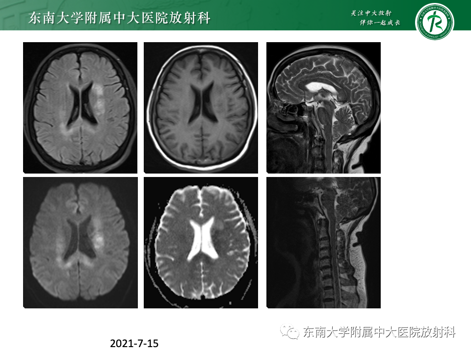影像PPT - 【PPT】成人常见脑白质病变影像诊断-6