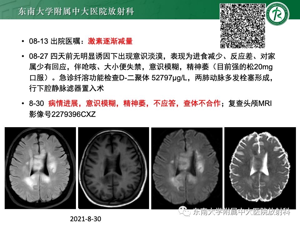 影像PPT - 【PPT】成人常见脑白质病变影像诊断-9