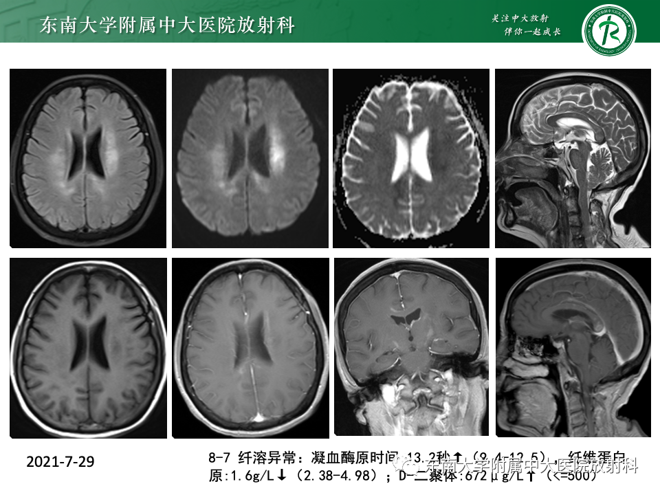 影像PPT - 【PPT】成人常见脑白质病变影像诊断-8